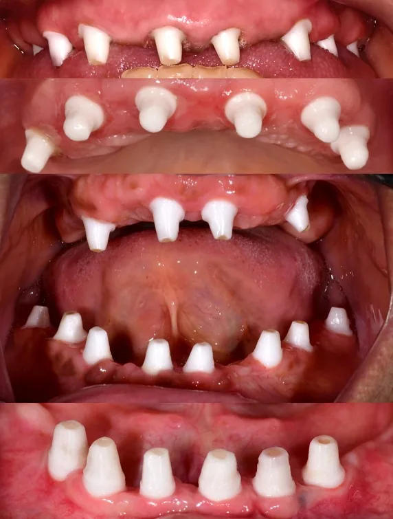 Natural Dentistry: All on X Full Mouth Ceramic Implants