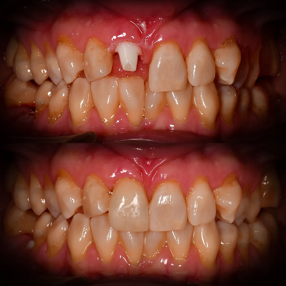 Natural Dentistry: CaseA 1 Front Tooth Implant