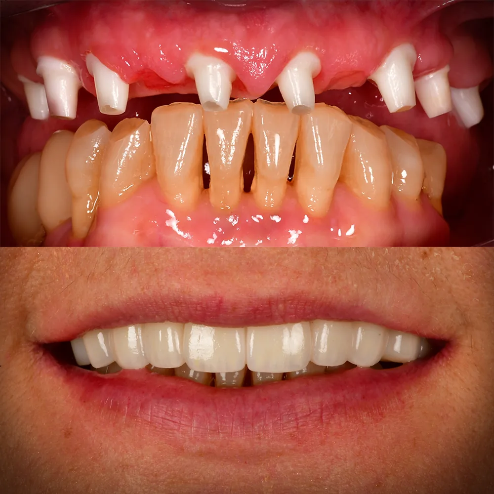 Natural Dentistry: CaseA Full Arch Ceramic Implants All on X Upper