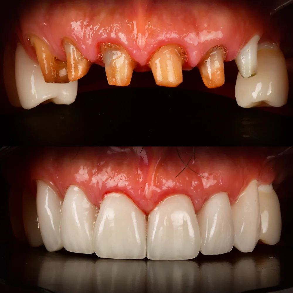 Natural Dentistry: CaseB Full Mouth Reconstruction w Ceramic Implants