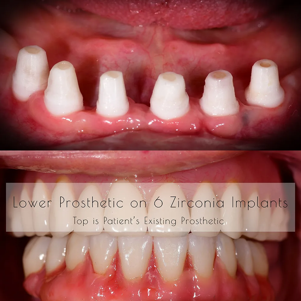 Natural Dentistry: CaseC All on 6 Full Arch Ceramic Implants Lower