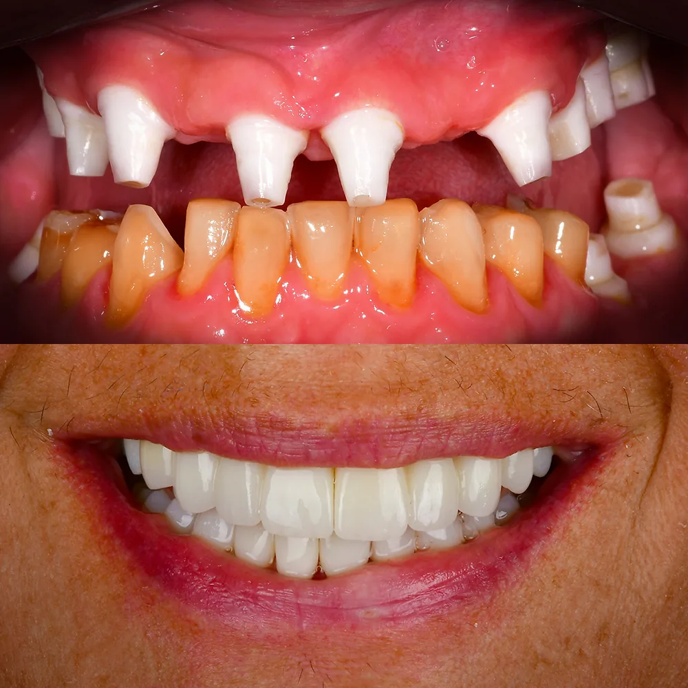 Natural Dentistry: CaseC Full Arch Ceramic Implants All on X Upper Jaw