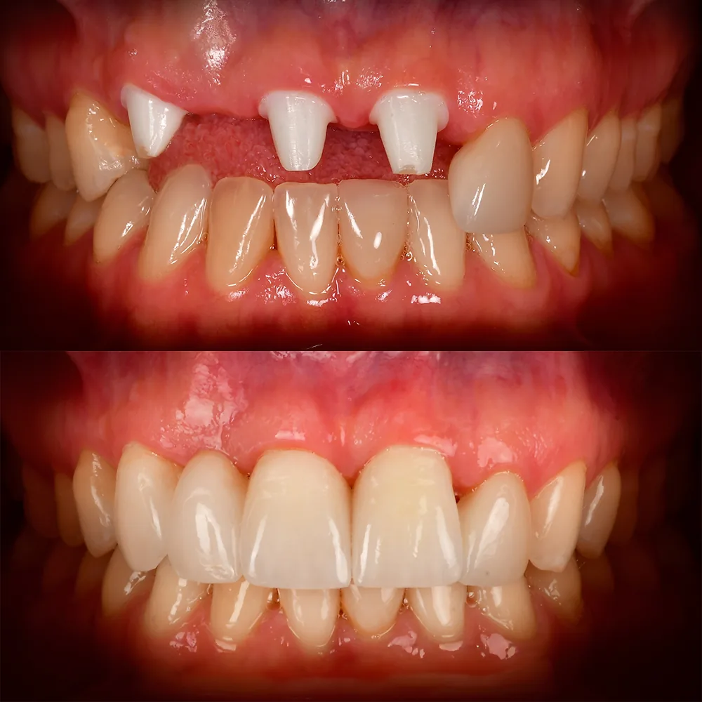 Natural Dentistry: CaseJ 3 Front Tooth Ceramic Implants