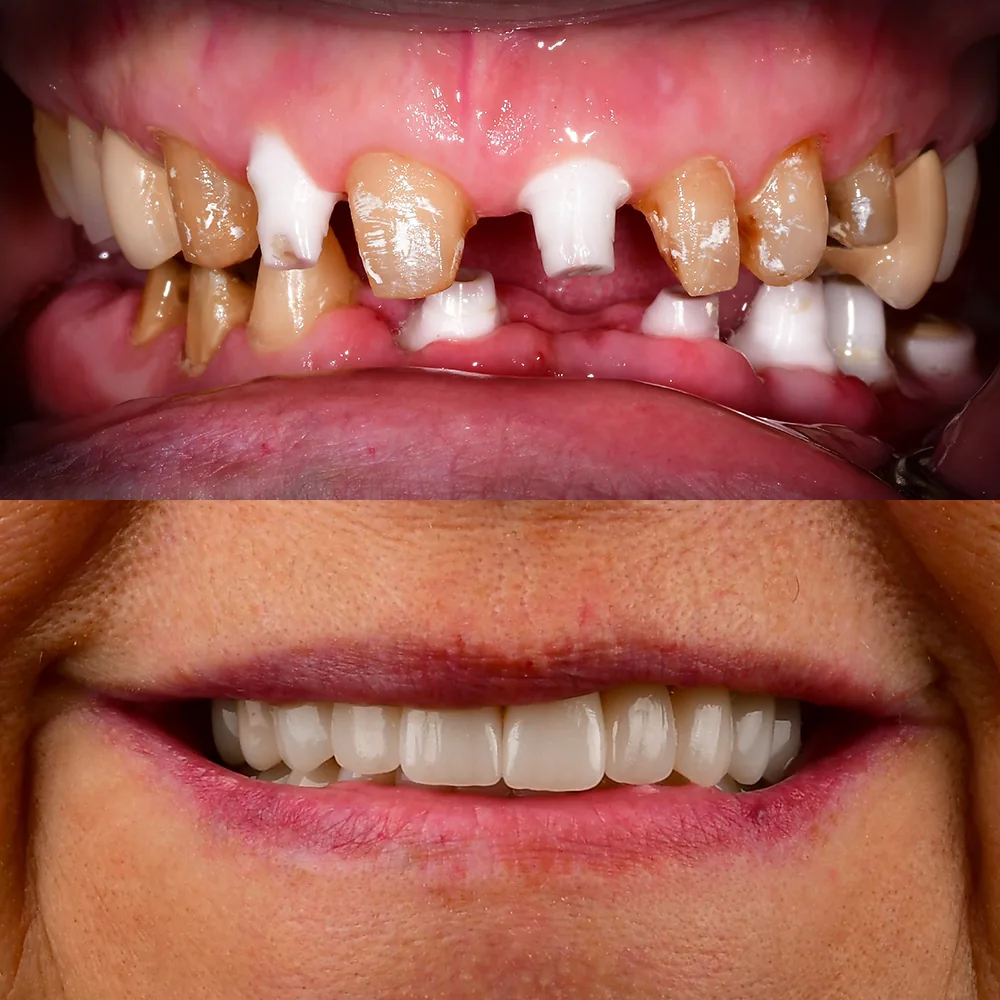 Natural Dentistry: CaseL Front Tooth Ceramic Implants Full Mouth Reconstruction