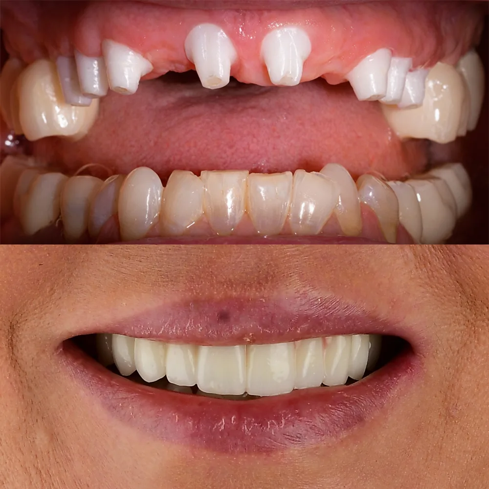 Natural Dentistry: CaseM Full Arch Front Tooth Implants All on X Ceramic Implants