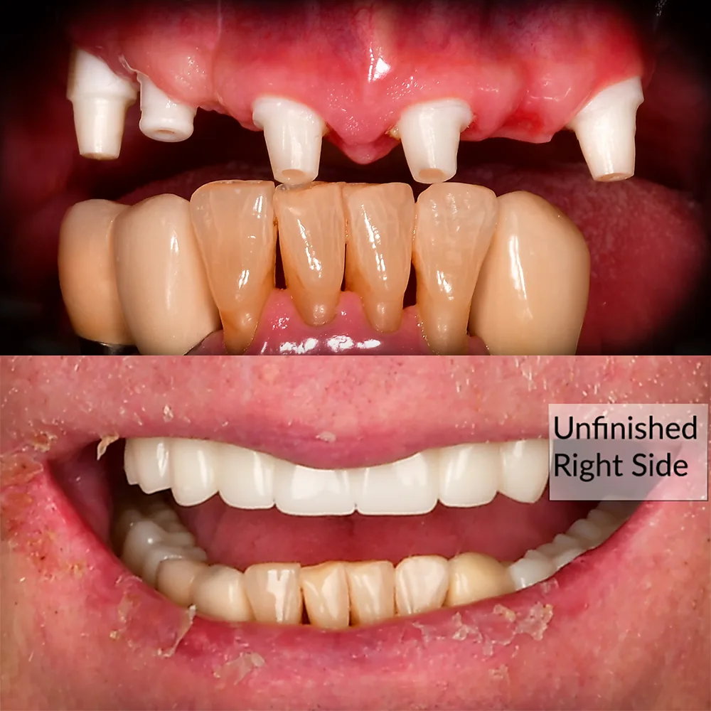 Natural Dentistry: CaseP Full Ceramic Implants Arch On X Upper Arch