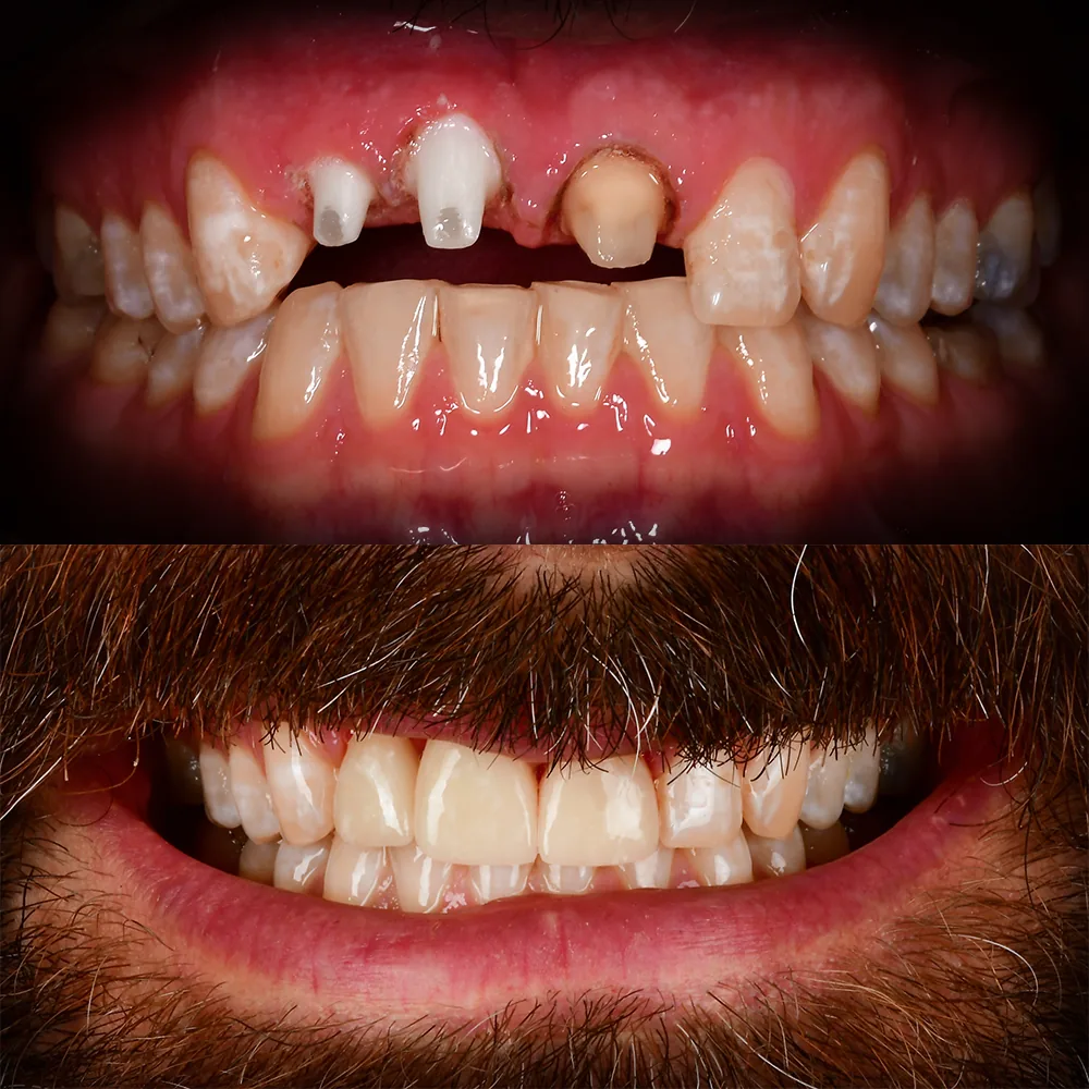 Natural Dentistry: CaseS 2 Front Tooth Ceramic Implants