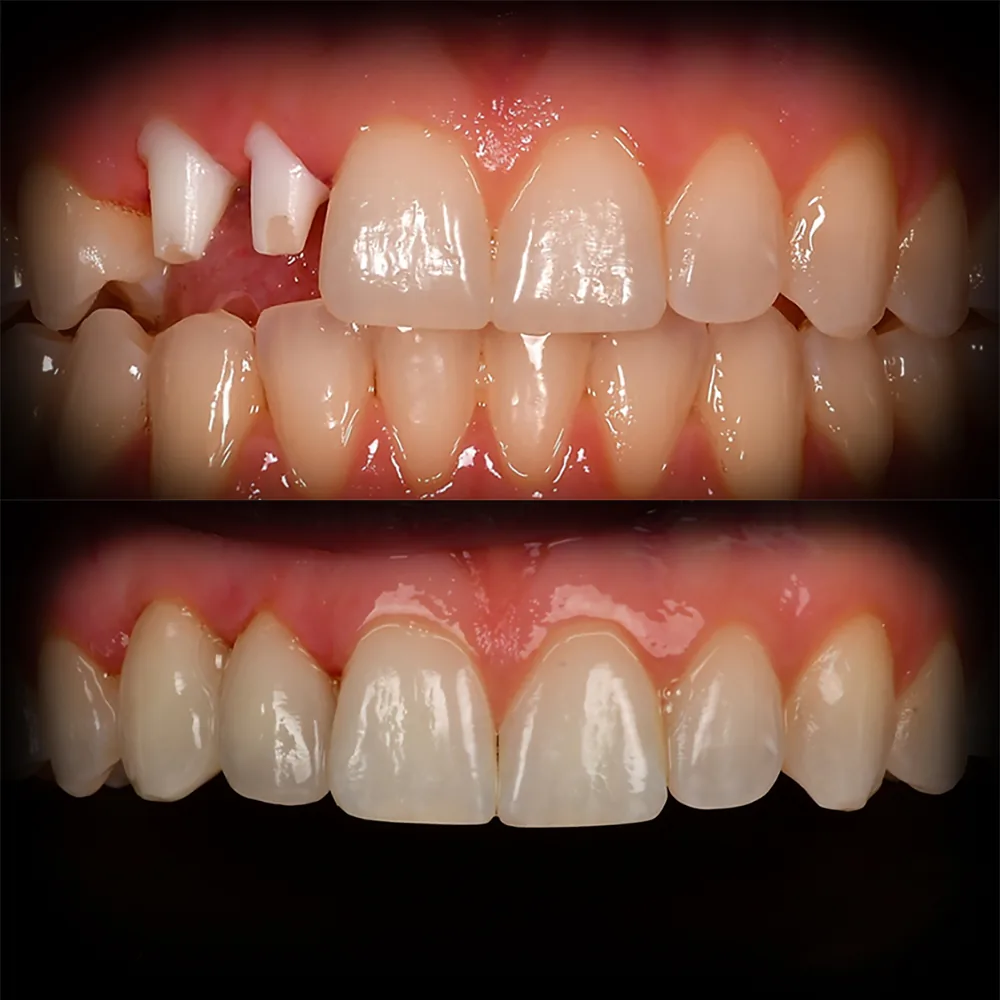 Natural Dentistry: CaseS Front Tooth Ceramic Implant