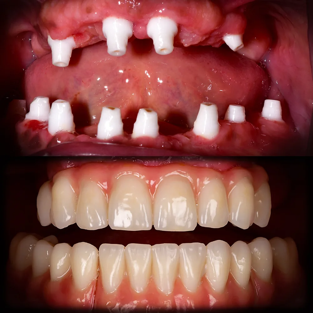 Natural Dentistry: CaseY DOUBLE ARCH All on X Ceramic Implants