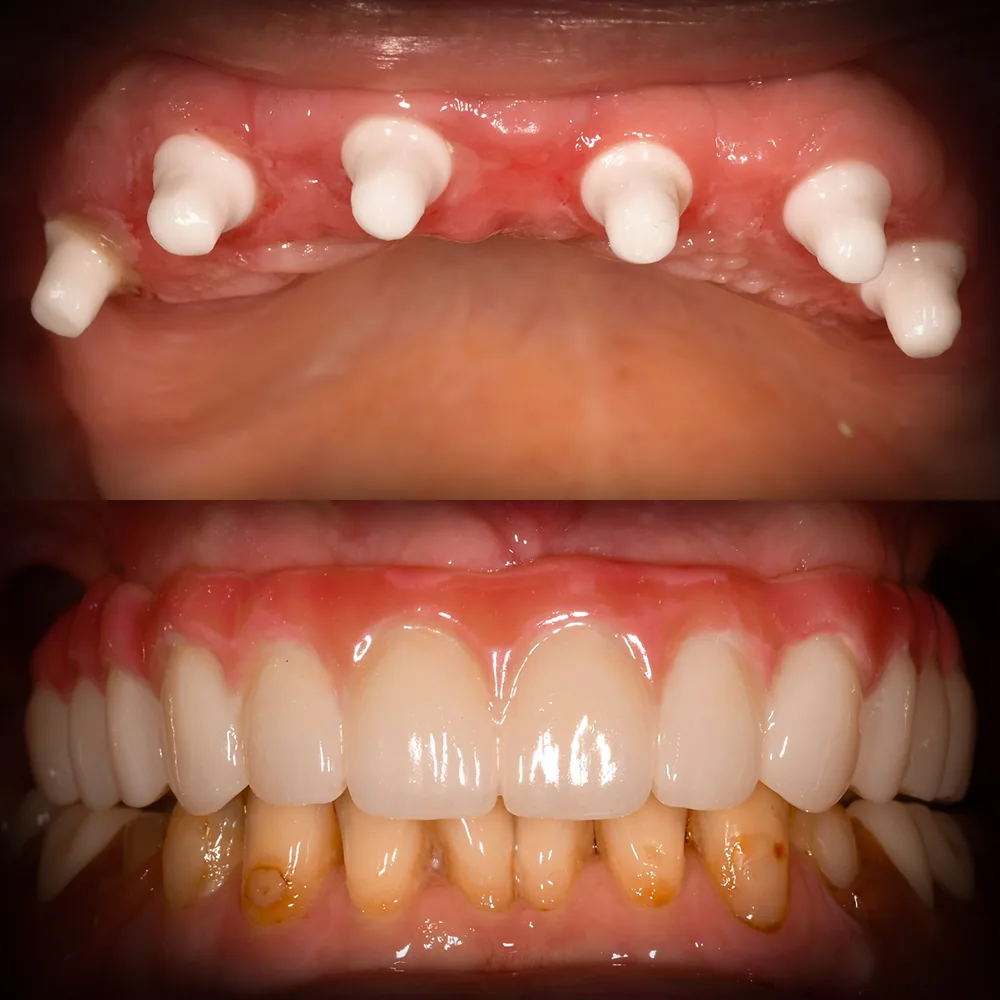 Natural Dentistry: CaseY Full Mouth Ceramic Implants All on 6 Upper