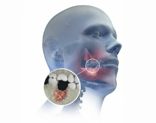 Natural Dentistry: cavitations3