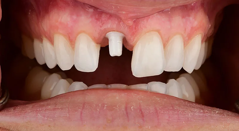 Natural Dentistry: front tooth implant 1