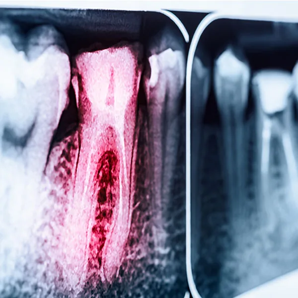 Natural Dentistry: root canal alternatives 1