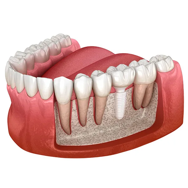 Natural Dentistry: zirconia implants